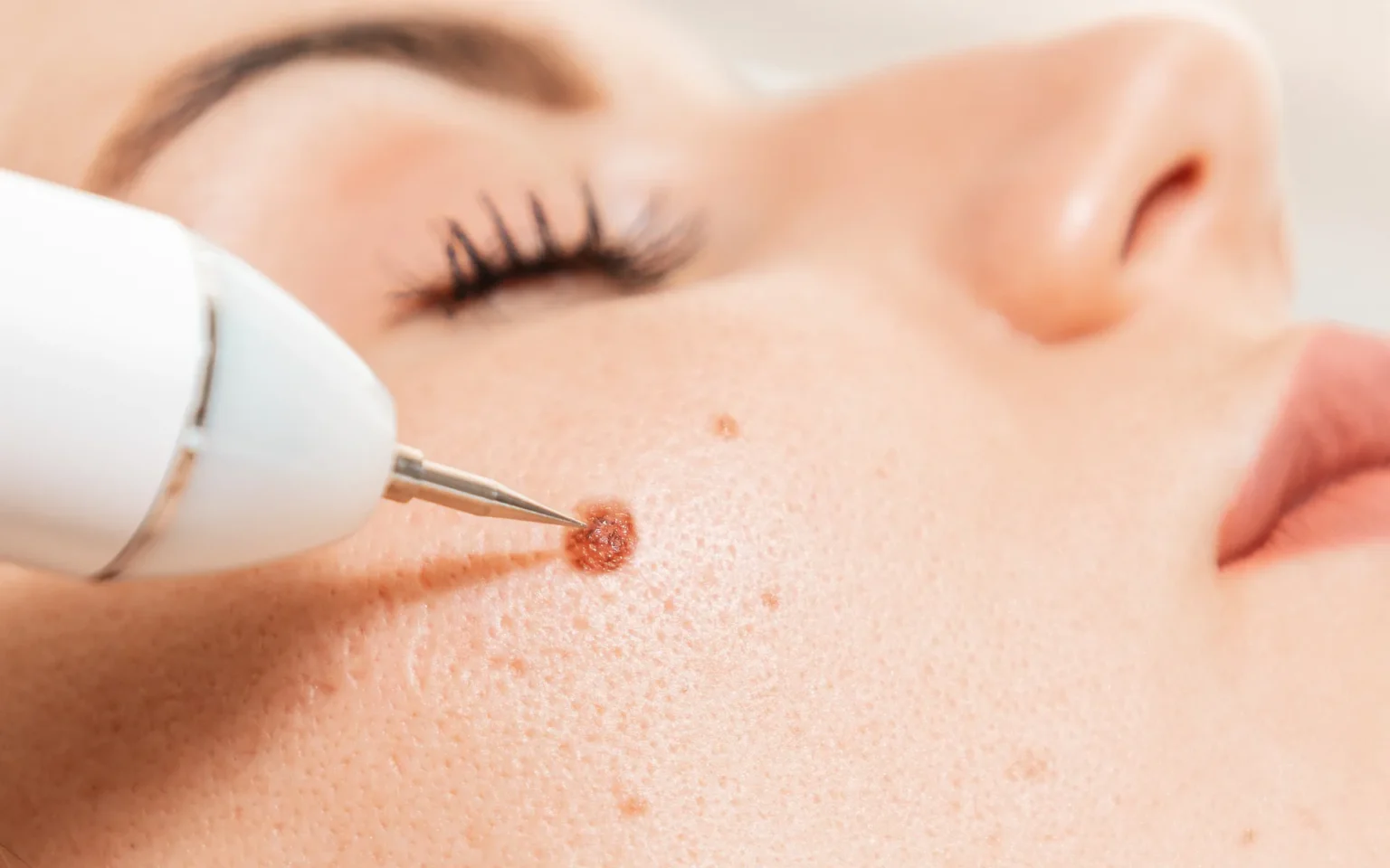 Skin Tag Removal in Dubai